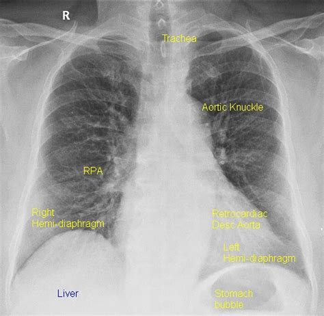 Chest (PA view) .